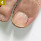 アスリートネイル スポーツネイルテープ(足爪用)athlete nail sports nail tape foot